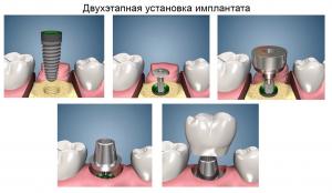 Сегодня двухэтапная имплантация – обычная (хотя и недешевая) хирургическая операция